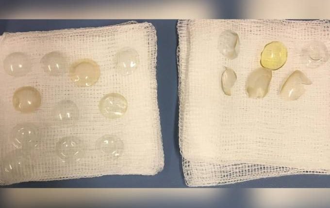 medicos-encontram-lentes-de-contato-paciente